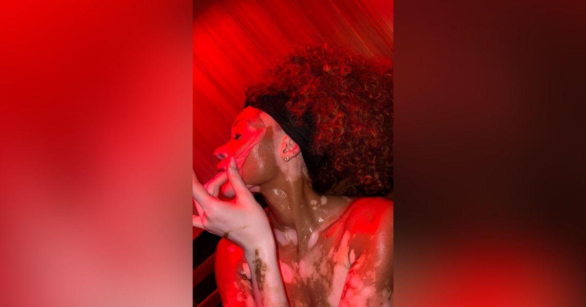 image of Winnie Harlow has been open about embracing her vitiligo and inspiring others.
