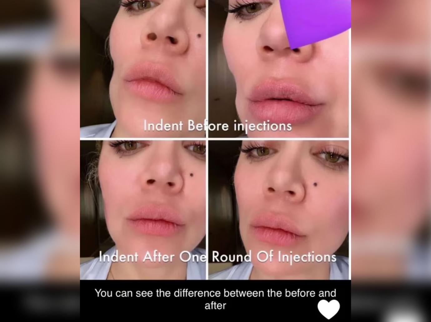 khloe kardashian facial filler surgery tumor cheek before after photos