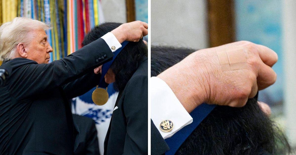 image of The White House said Donald Trump’s hand bruising came from handshakes and aspirin.