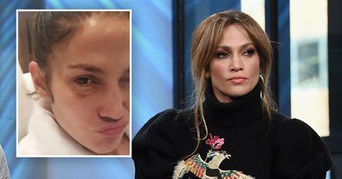 Jennifer lopez black eye photo