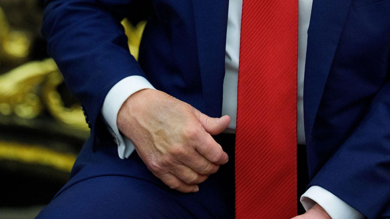 Image of The White House previously attributed Donald Trump’s bruising to frequent handshaking and aspirin use.