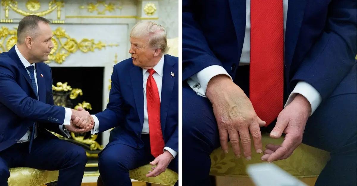 Photo of The president was diagnosed with chronic venous insufficiency over the summer.