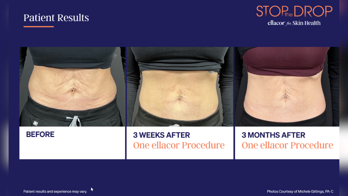 after the weight loss boom skin laxity is becoming the next aesthetic conversation