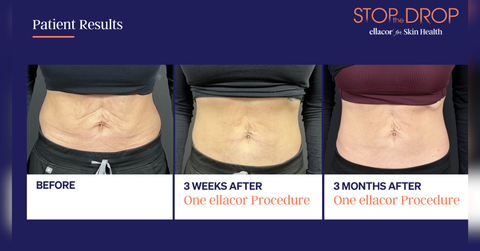 after the weight loss boom skin laxity is becoming the next aesthetic conversation