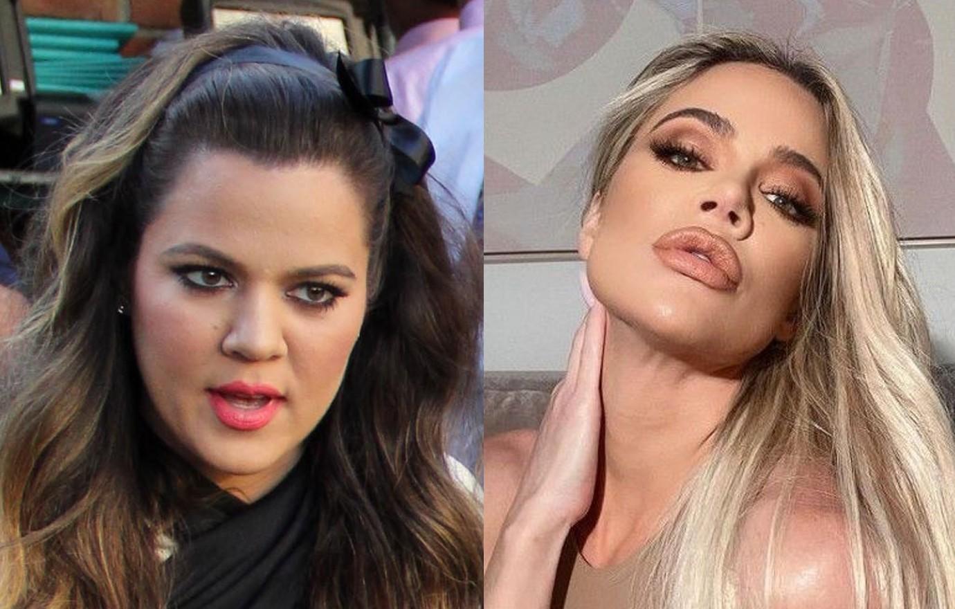 plastic surgery khloe kardashian