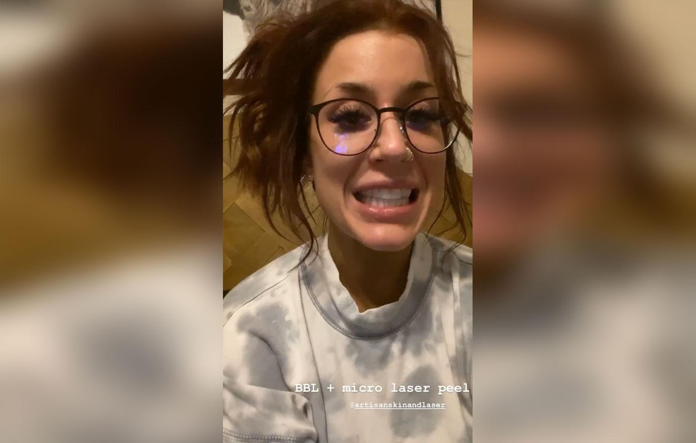 chelsea-houska-instagram-facial-peel-results-video