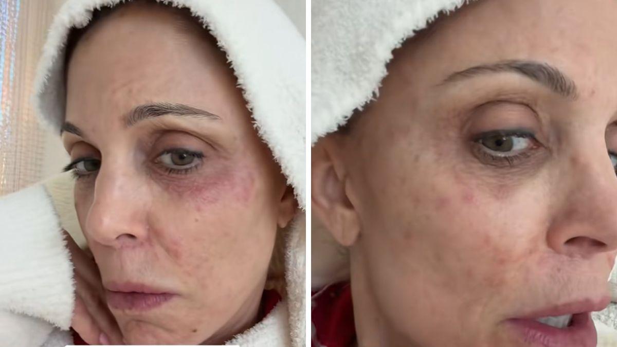 bethenny frankel health woes stage  chronic kidney disease everything to know