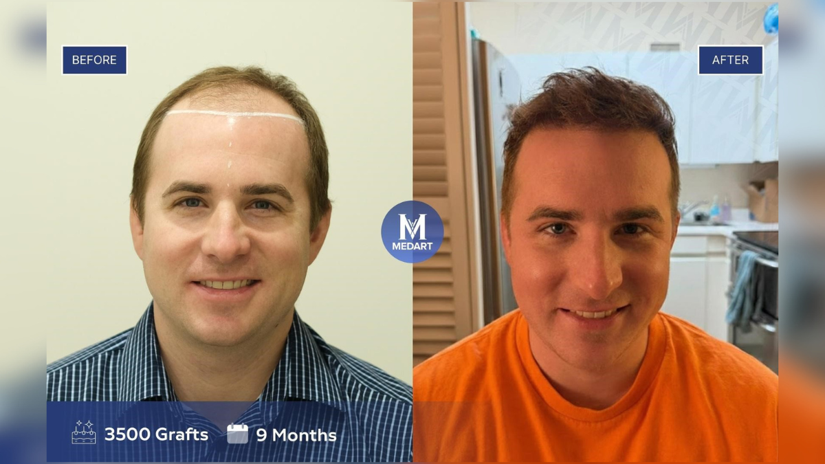 top  surgeon led vs top  high volume hair transplant clinics in turkey for complex and high norwood cases
