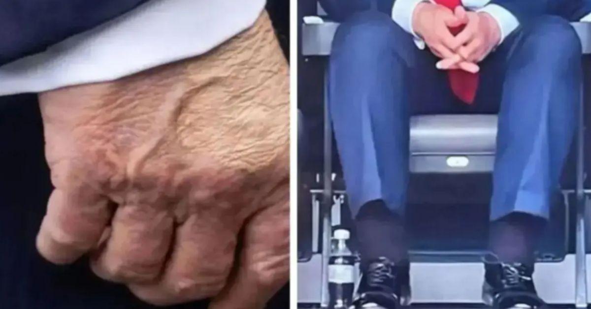 image of The president also hates using compression socks for his swollen ankles.