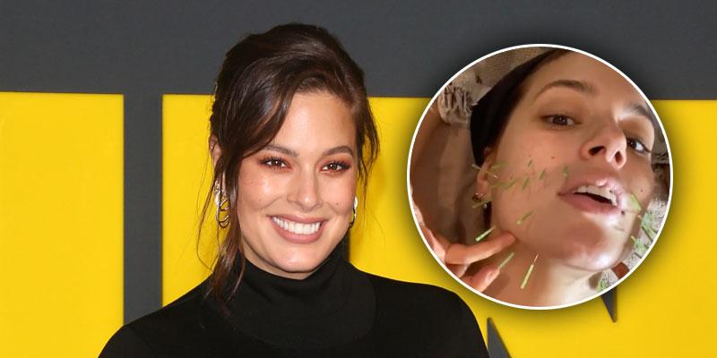 Ashley Graham Gets Acupuncture And Cupping Therapy To Help With Pregnancy 5944