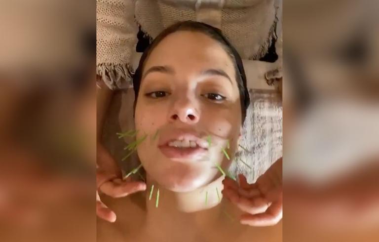 Ashley Graham Gets Acupuncture And Cupping Therapy To Help With Pregnancy 2996