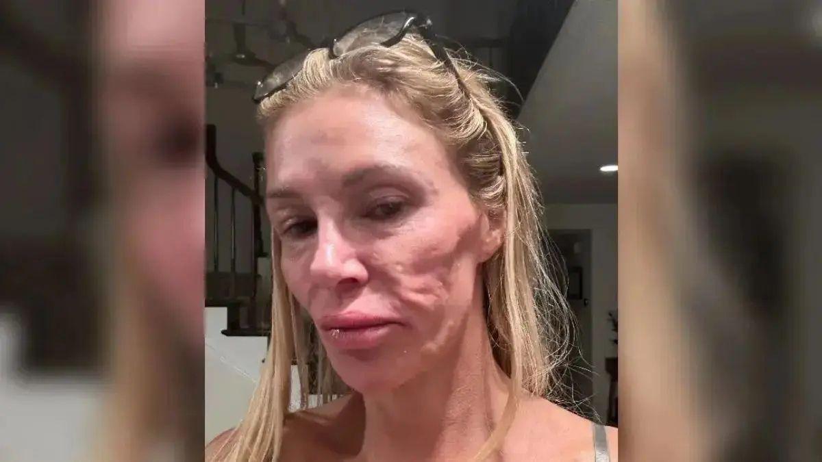Photo of Brandi Glanville's ruptured b----- implant caused multiple health complications.