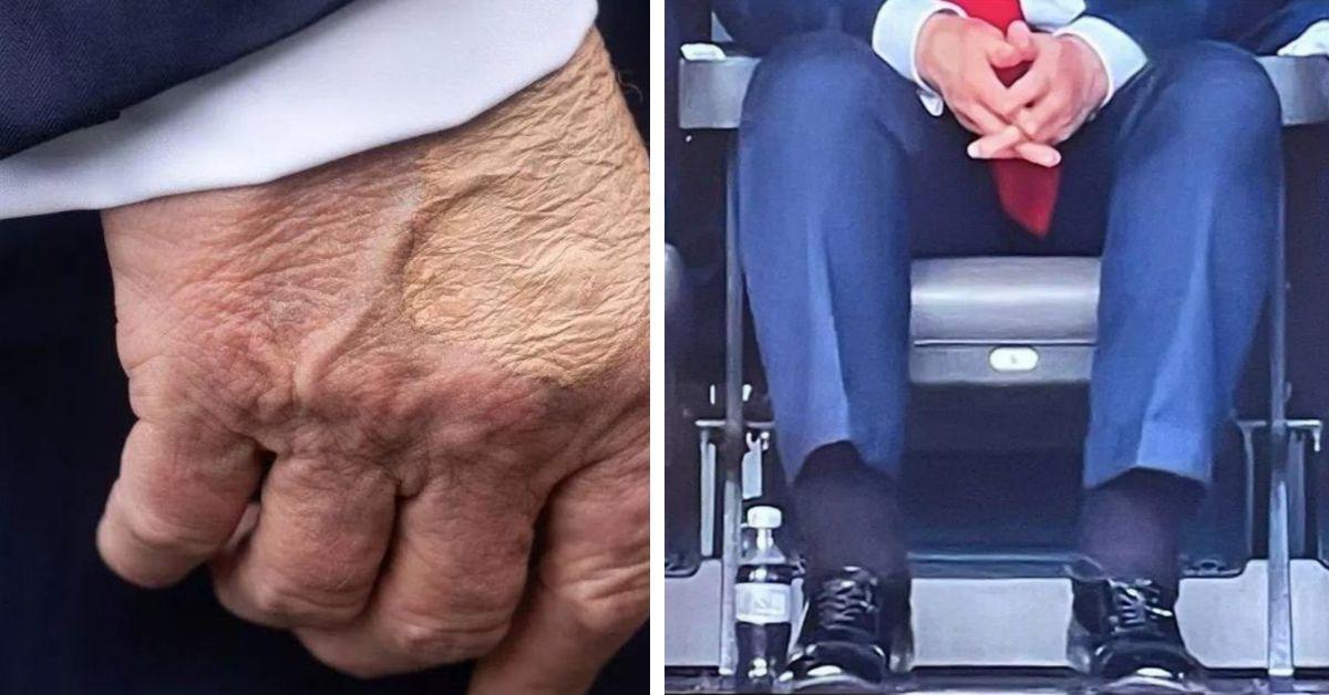 image of Donald Trump appeared with swollen ankles and a large bruise on his hand during some events. 