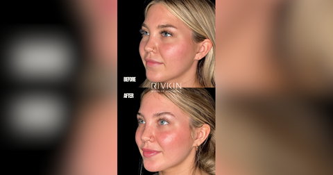 Love Island's Hannah Fields' Rivkin Aesthetics Filler Transformation