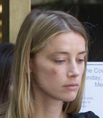 Amber Heard Leaves Court With Bruised Face After Johnny Depp Domestic