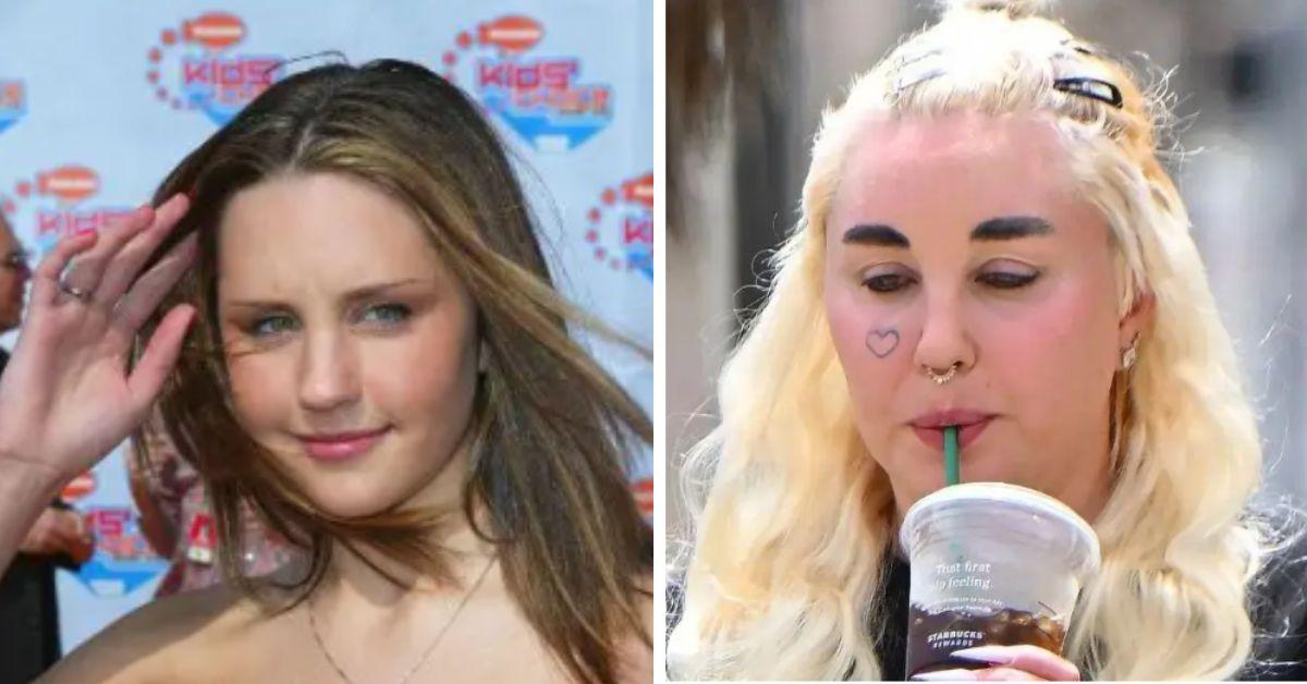 image of Amanda Bynes has been open about her cosmetic procedures.