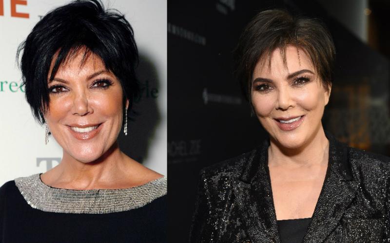 Kris jenner celebrity plastic surgery