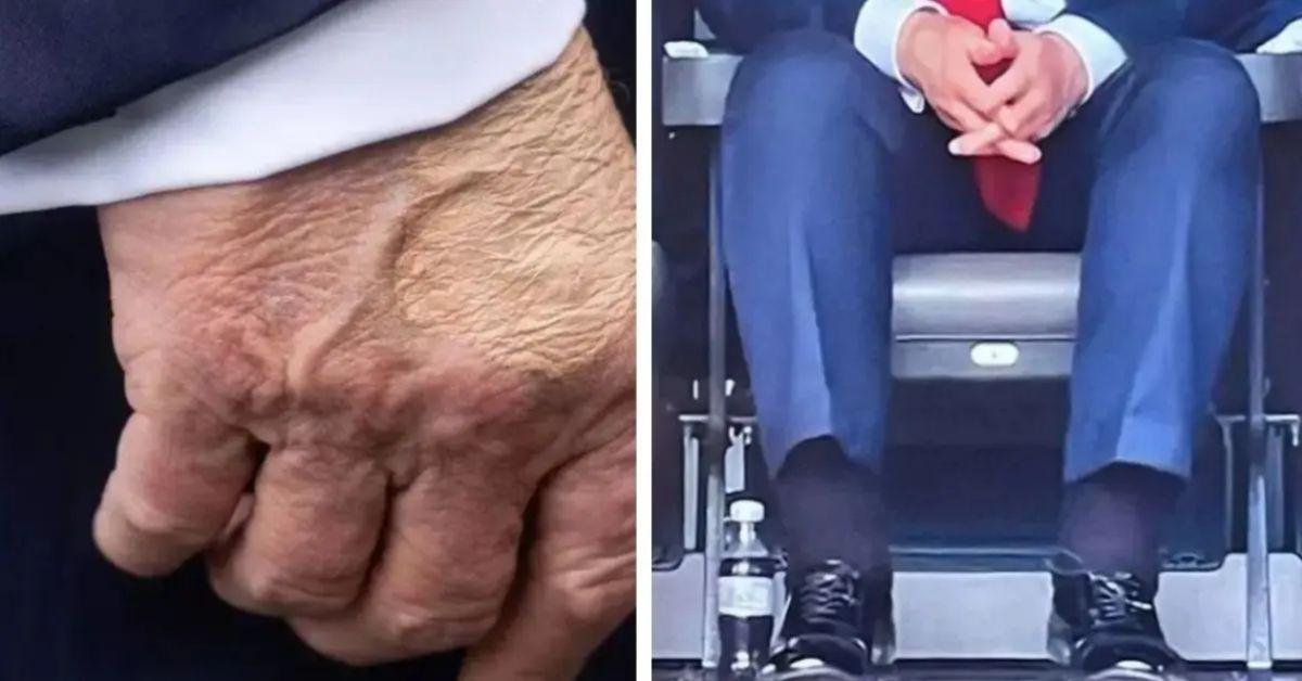 image of Photos of Donald Trump’s swollen ankles and bruised hand have sparked new health questions.