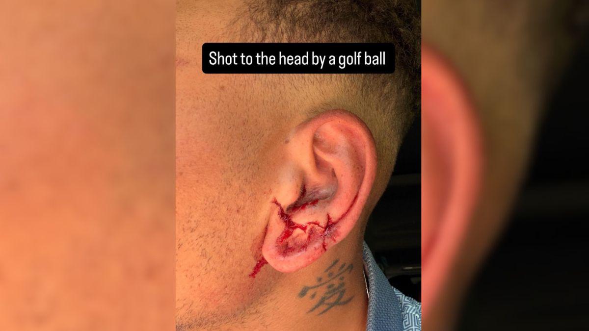 Image of Kane Brown revealed that one of his friends accidentally hit him while playing golf.