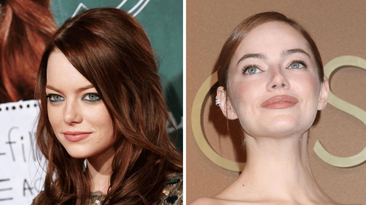 Photo of Emma Stone has never confirmed any plastic surgery procedures.