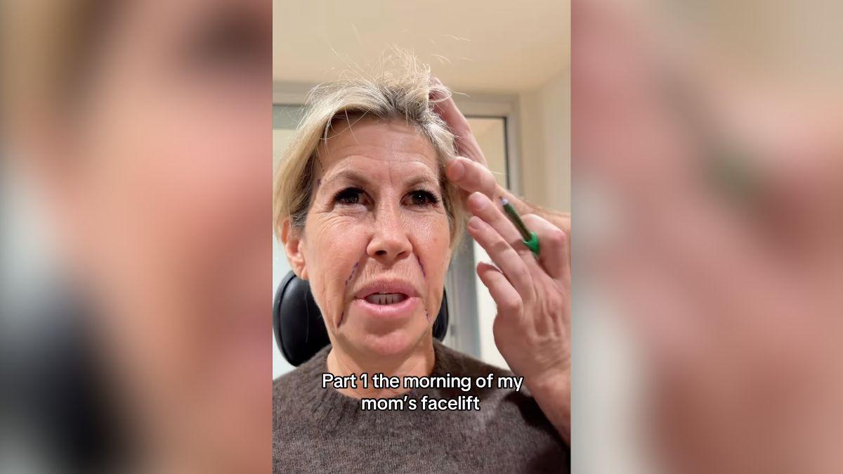 Image of The reality star described a severe reaction following filler dissolution.