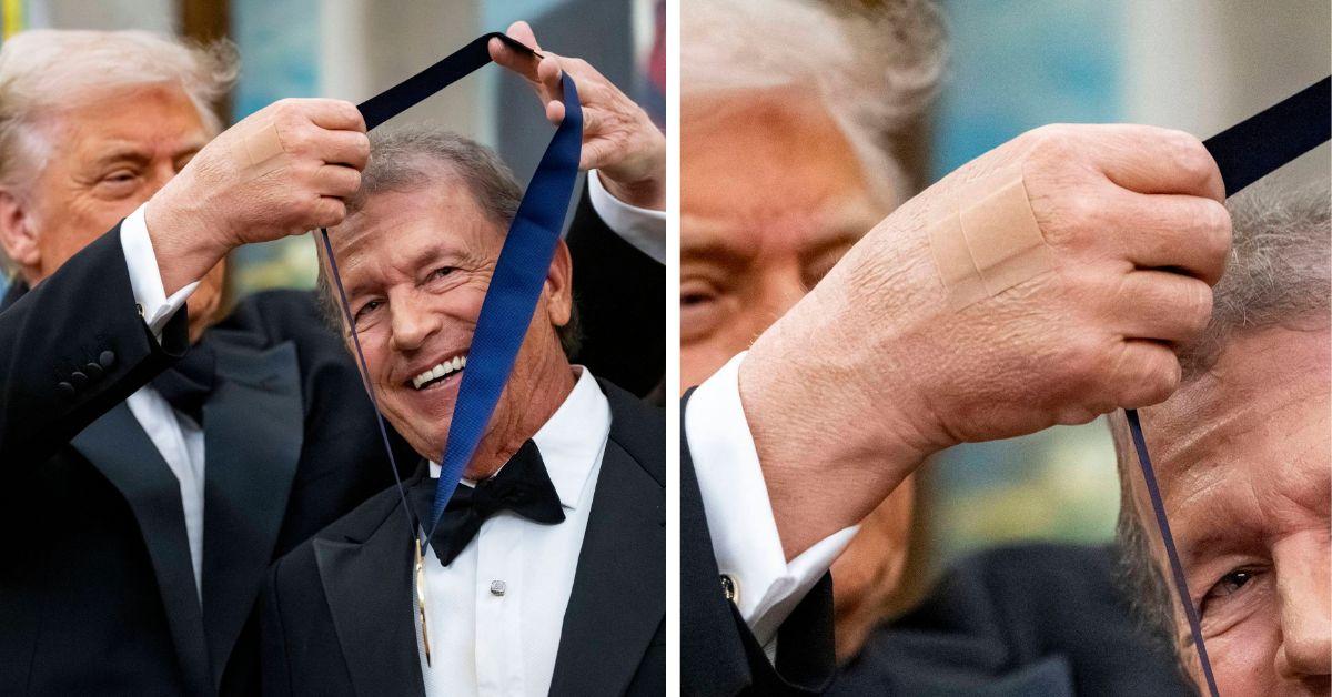 image of The White House blamed the bruising on 'constant handshaking.'