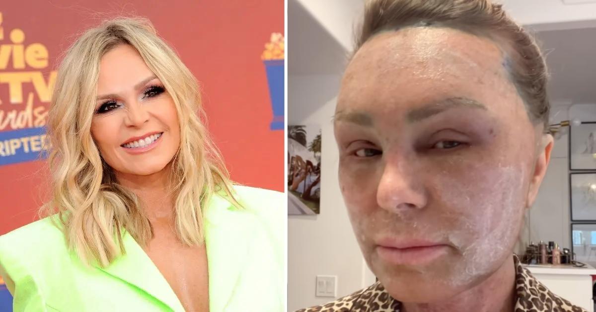 Photos of Tamra Judge before and after recent plastic surgery procedures.