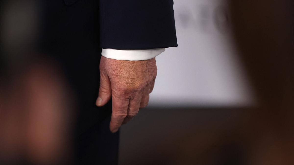 Photo of Donald Trump often wears makeup on his bruised hands.