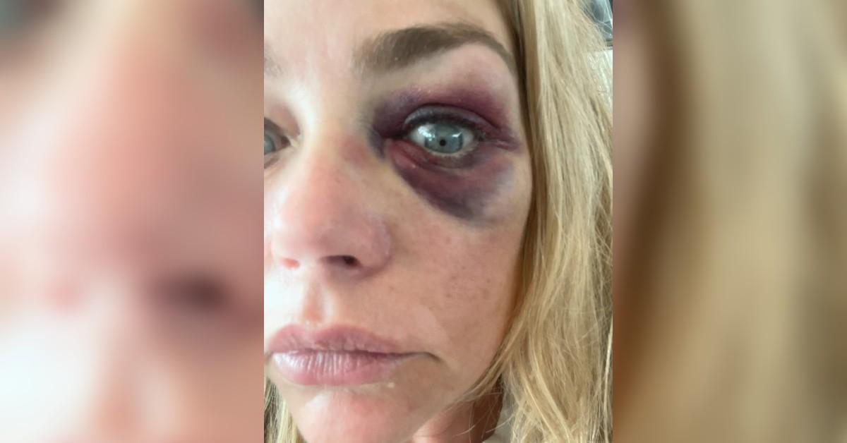 image of Denise Richards included photos of her black eye in her legal filing.