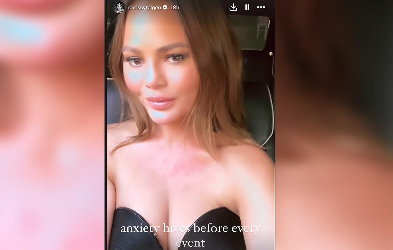 chrissy teigen anxiety hives latest red carpet event photo