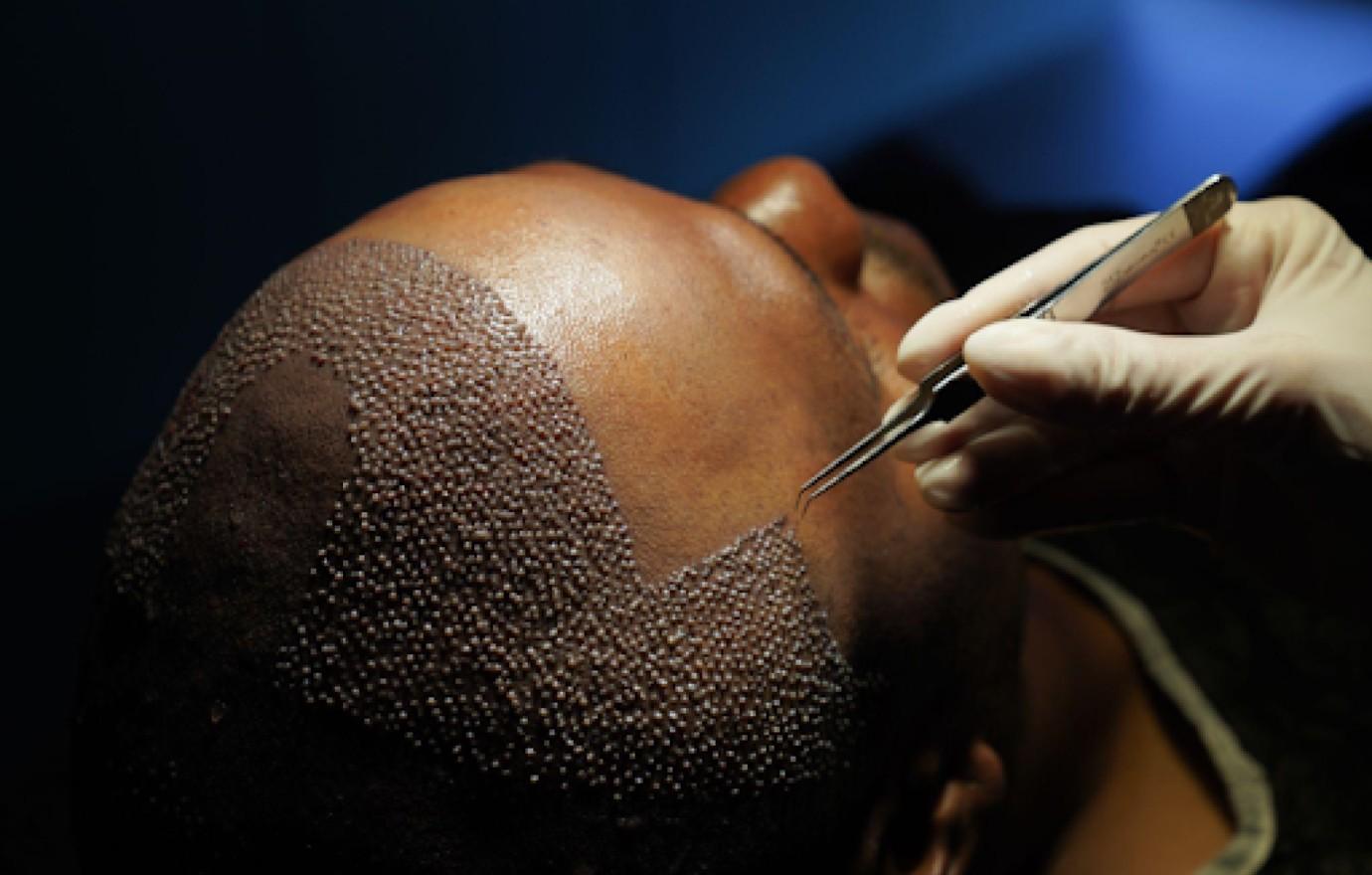 hair transplant