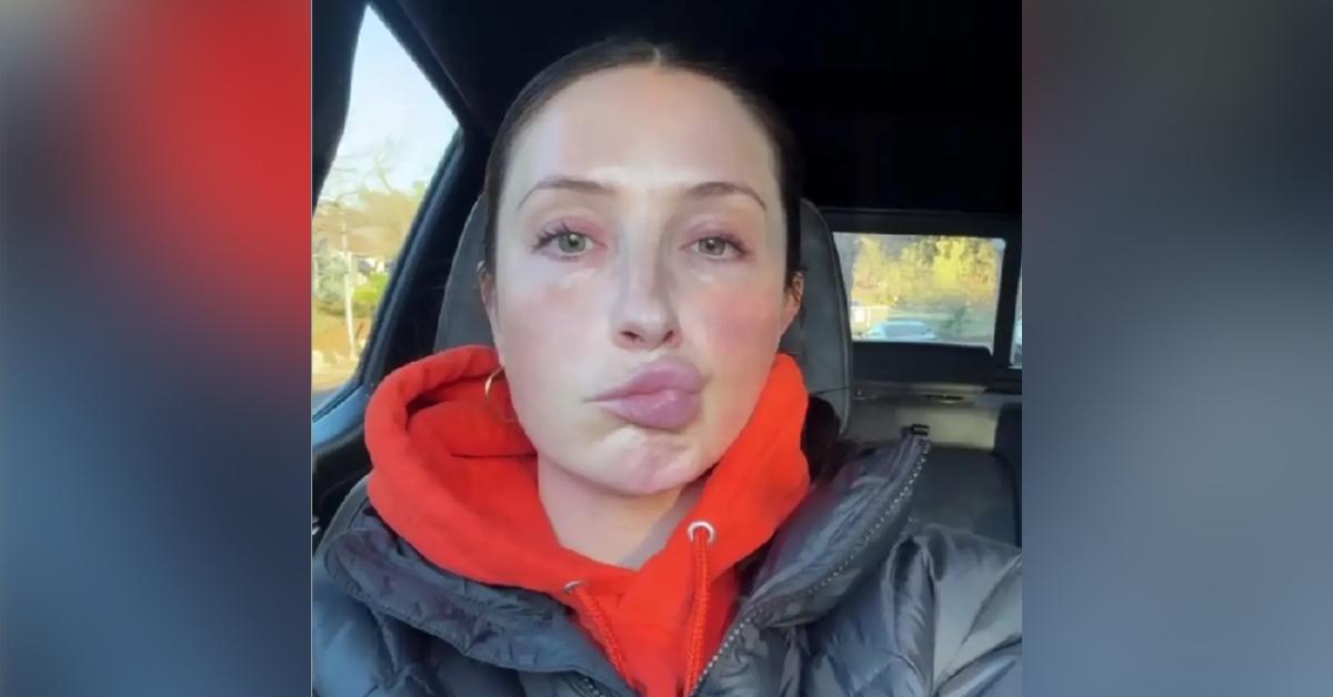 Photo of Palin's doctors said it could be a case of Bell's palsy.