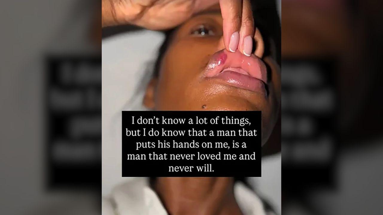 Photo of Jazzma Kendrick showed images of the injuries Ross allegedly inflicted. 