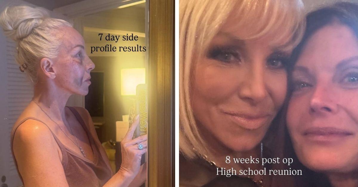 image of Margaret Josephs shared before-and-after photos of her recovery.