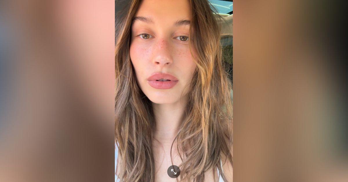 image of The Rhode founder has been open about her skin condition for years.