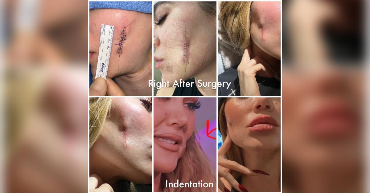 khloe kardashian healing removing cancerous tumor face photos