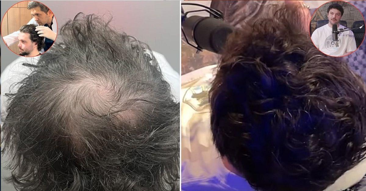 baldstool rudy before after pic