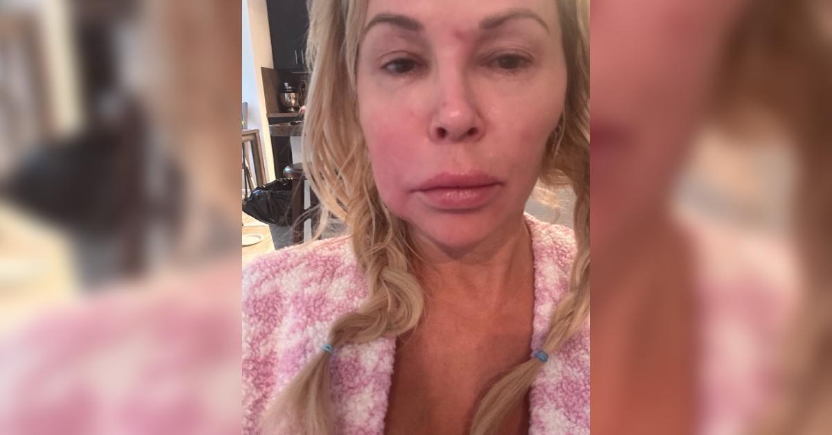 brandi glanville botched terry dubrow swollen face photo health