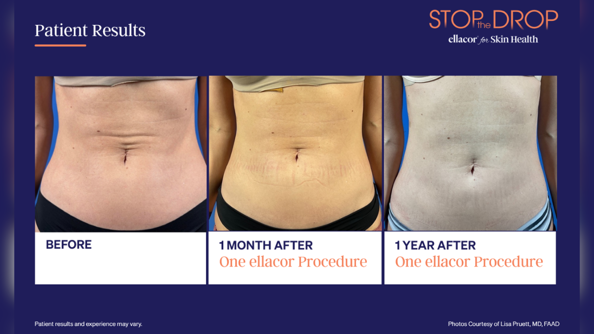 after the weight loss boom skin laxity is becoming the next aesthetic conversation