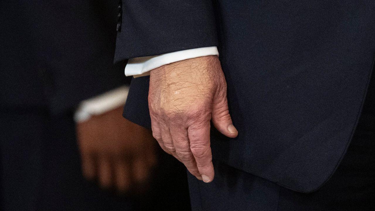 Photo of Trump's hands are among the several visible signs of his physical decline.