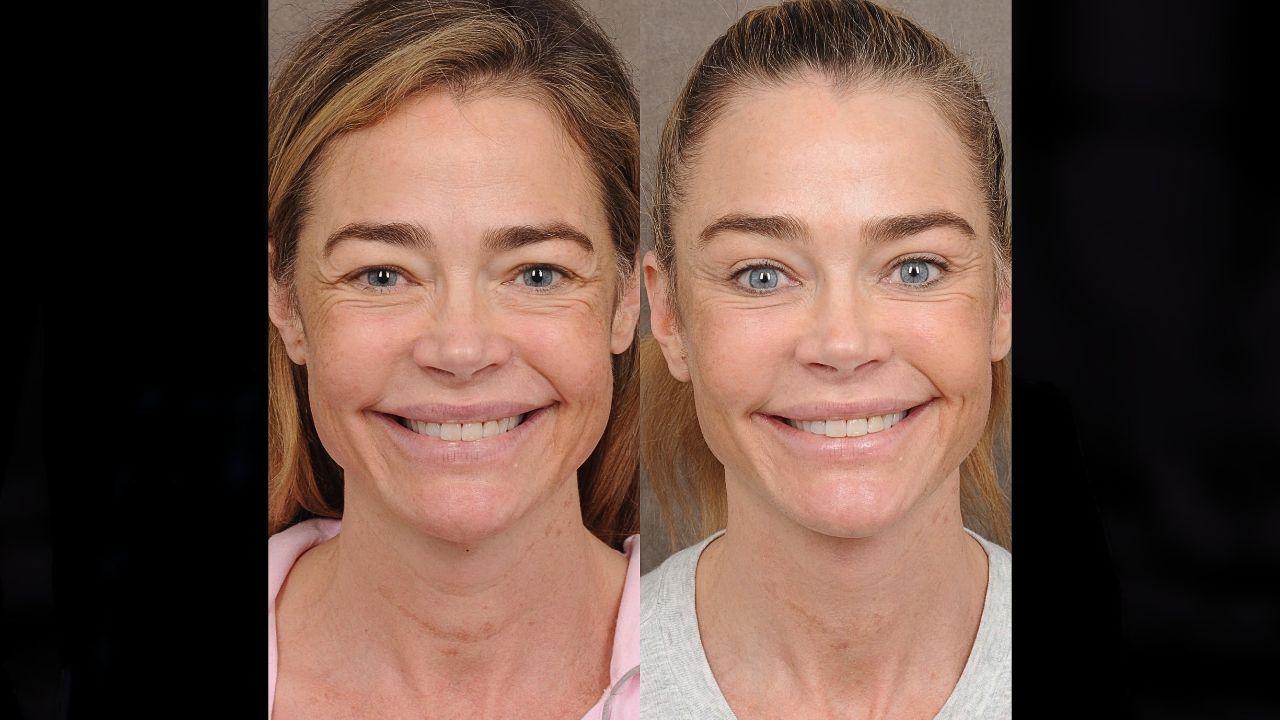 Image of Denise Richards before and after facelift.