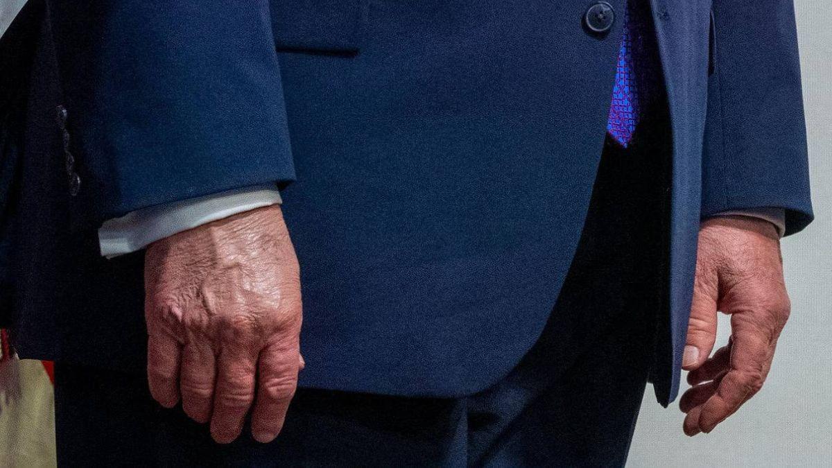 Image of Donald Trump attempted to cover his bruised hands with makeup during a TrumpRX event on May 18.
