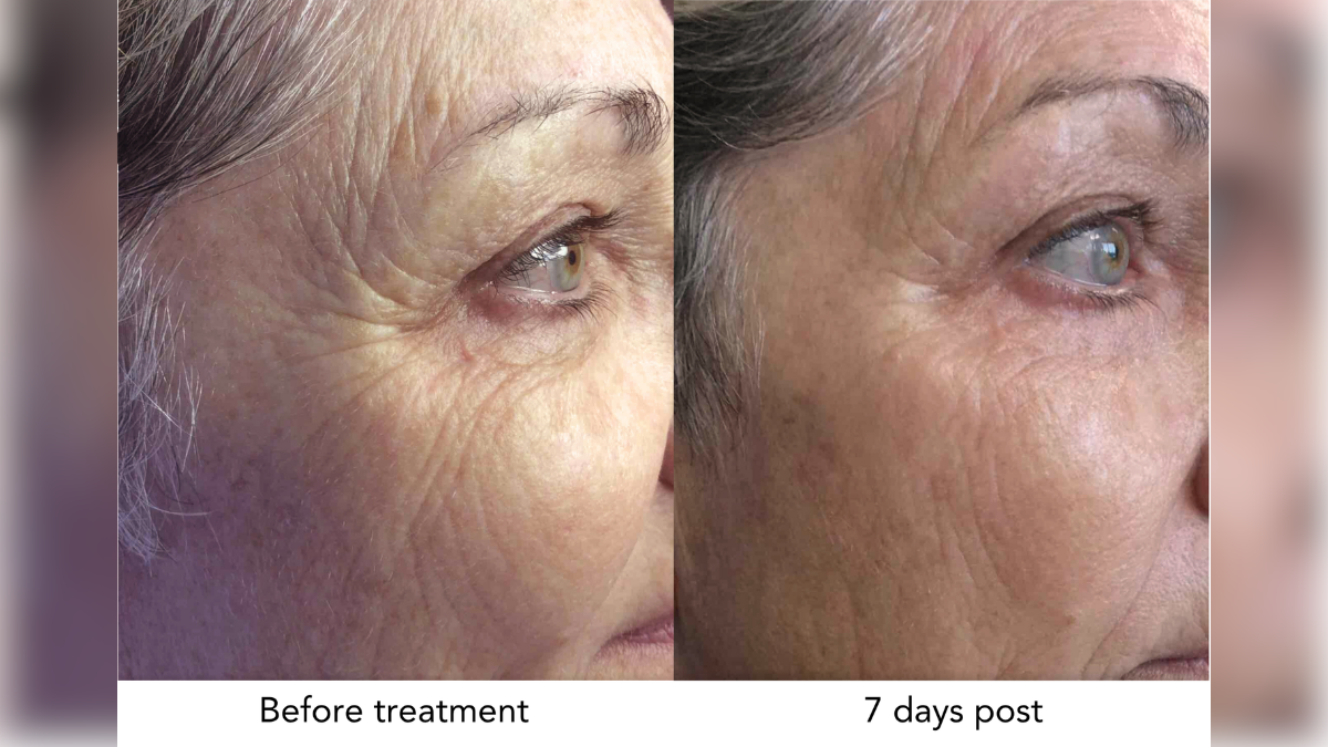 the minute celebrity skin secret powering the microneedling boom