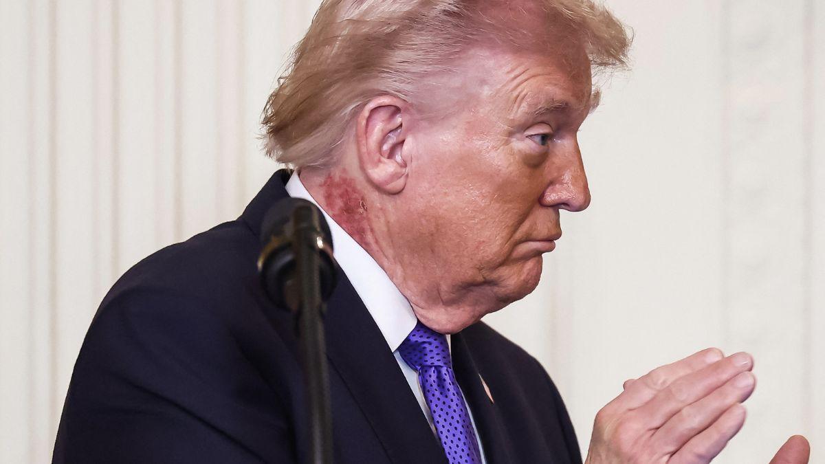 image of Donald Trump was seen with a rash on his neck.