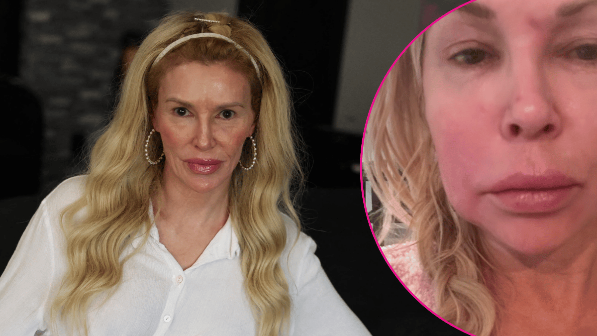 Image of Brandi Glanville shared that she has a benign tumor after finding out her facial parasite is back.