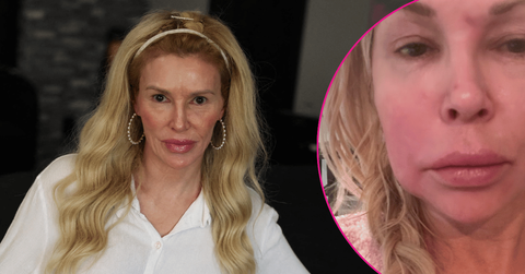 Image of Brandi Glanville shared that she has a benign tumor after finding out her facial parasite is back.