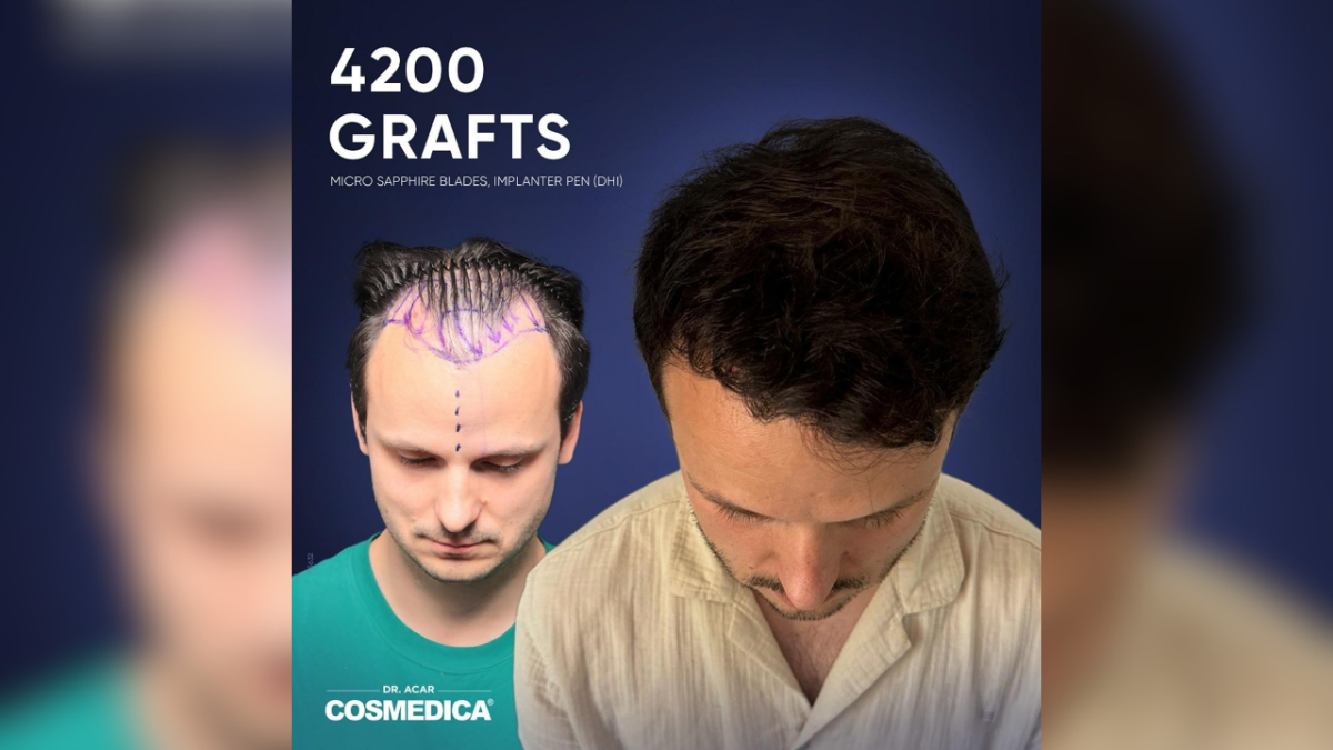 hair transplant in turkey a closer look at cost care and results