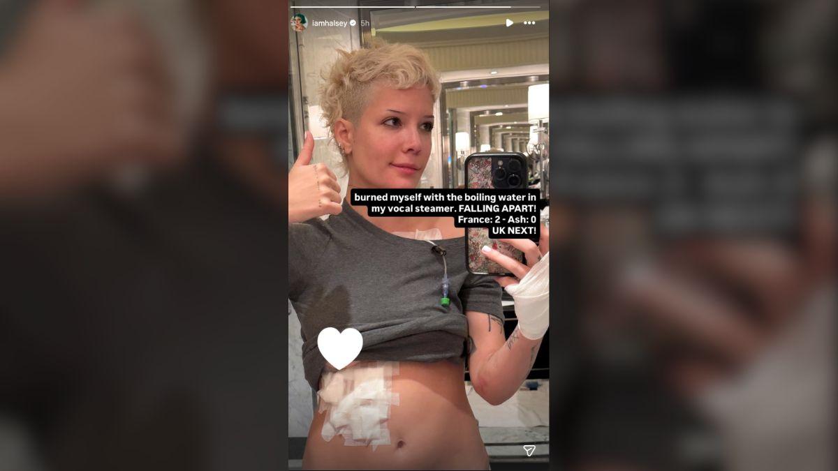 image of Halsey shared a candid update after revealing she suffered a recent injury while undergoing chemotherapy for a rare disorder.
