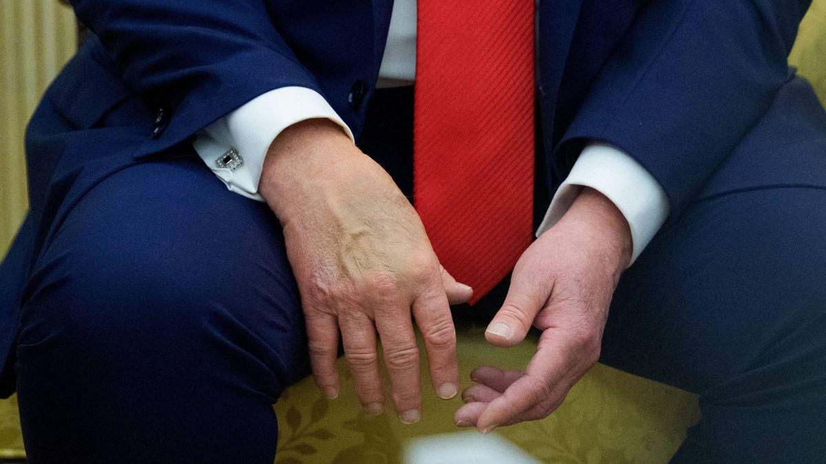 Image of The report addressed bruising on Donald Trump’s hands.