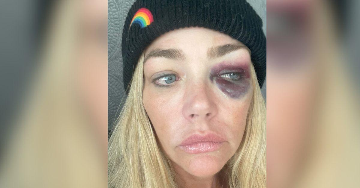 image of Denise Richards showed off her bruises.